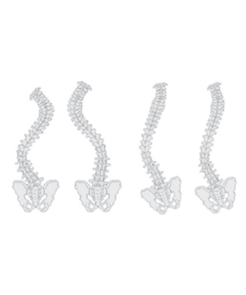 Escoliose Neuromuscular Sindr Mica Dr Andr Castilho